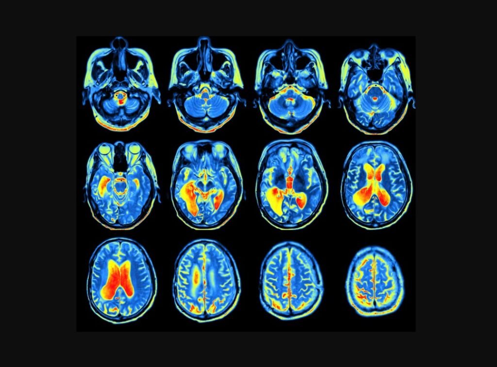 Alzheimer’s disease brain scan